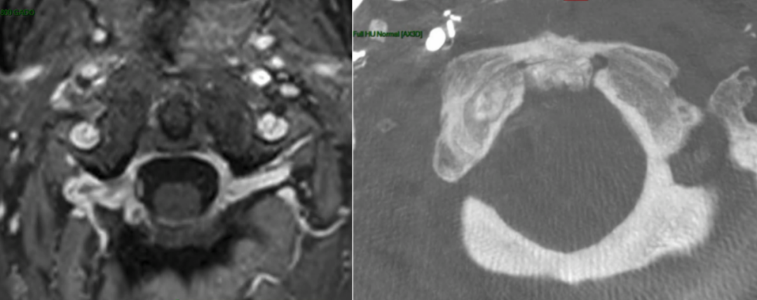 术后MRI，显示镜下全切