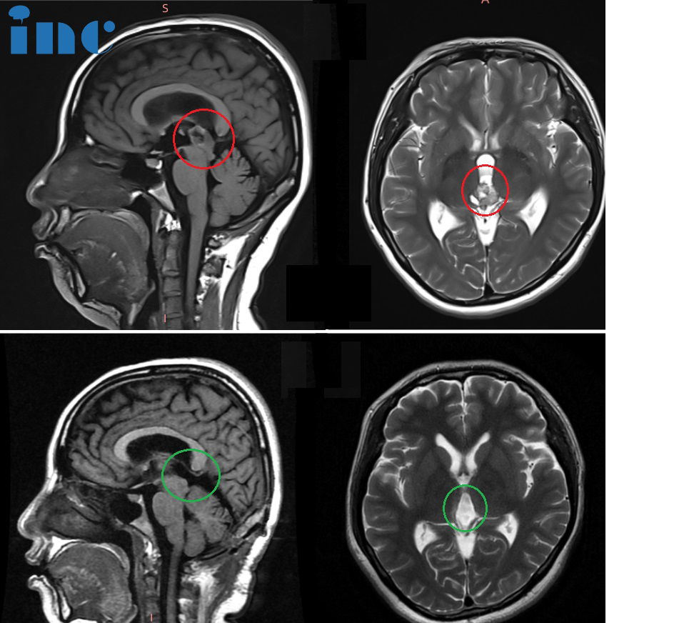 CASE 1：36岁女性-松果体区占位手术