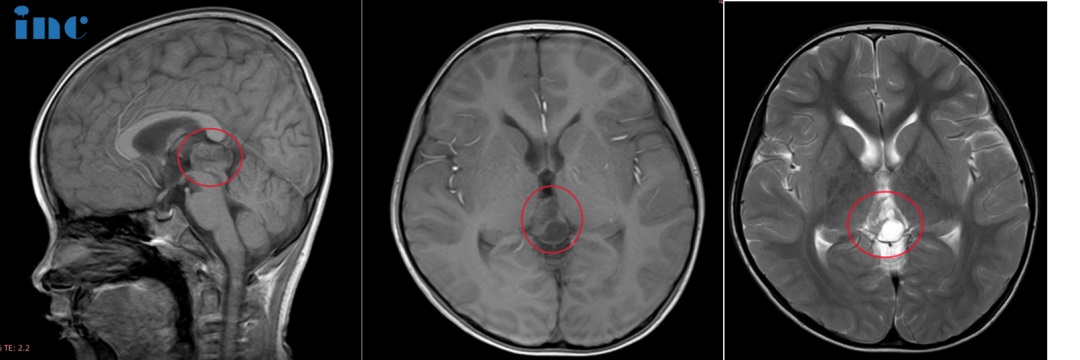 CASE 3：6岁男孩-松果体占位性病变