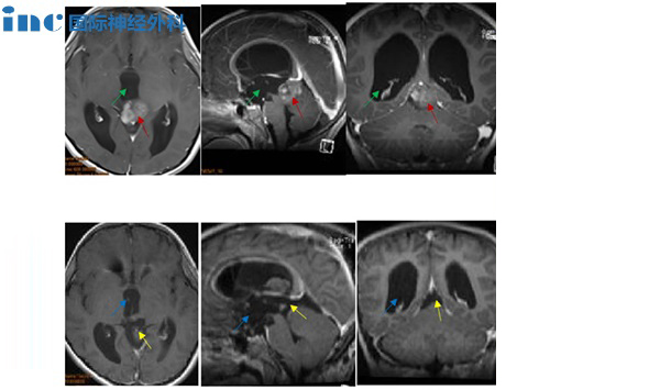 CASE 5：8岁男孩-松果体肿瘤
