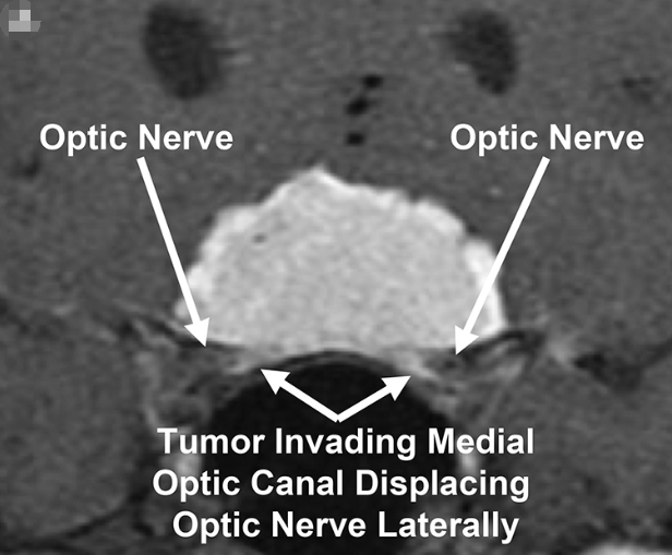 图：冠状位增强后T1加权MR图像显示双侧视神经管被鞍结节脑膜瘤侵犯