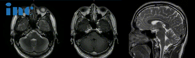 脑干-桥臂胶质瘤长大，三根重要神经包绕肿瘤