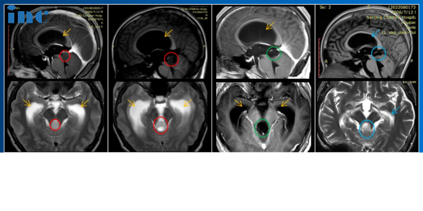 脑干胶质瘤保守治疗2年肿瘤压扁大脑，巴教授术后1年考上名校没有复发