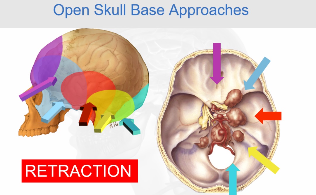 福教授颅底手术理念一：采用更微创的方法