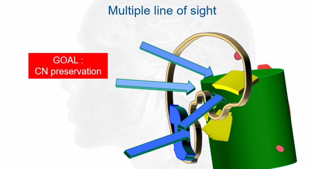 福教授颅底手术理念四：经岩骨入路的应用