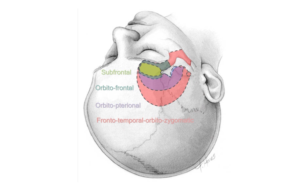 福教授颅底手术理念五：经眶入路在癫痫手术的妙用