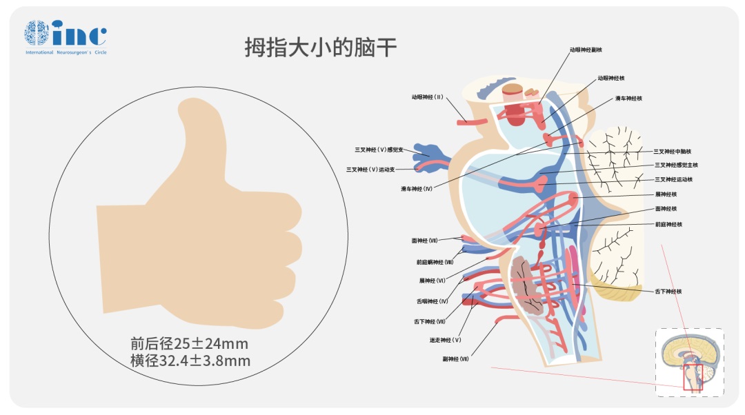 脑干海绵状血管瘤手术