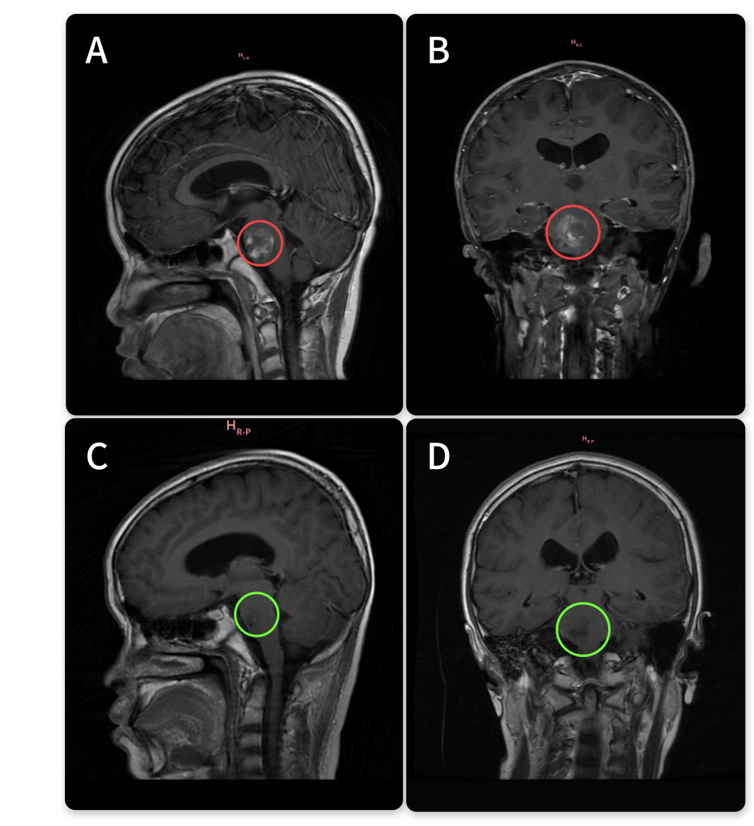 12岁男孩-脑桥海绵状血管里伴出血