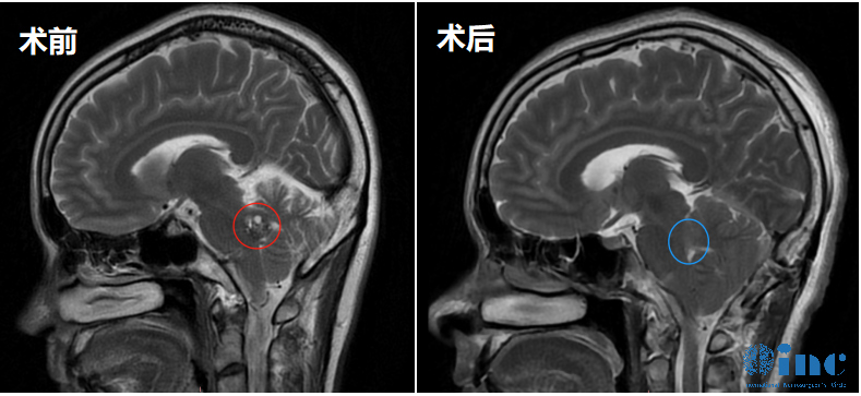 35岁女性-脑干桥脑海绵状血管瘤
