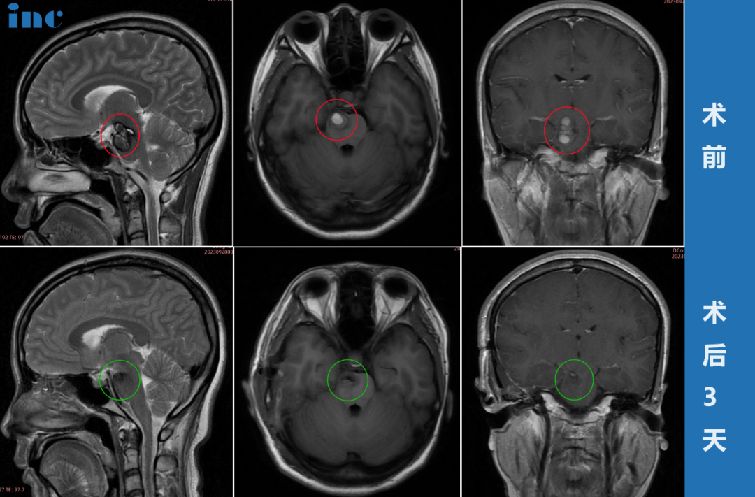 30岁女士•脑干-中脑及桥脑海绵状血管瘤