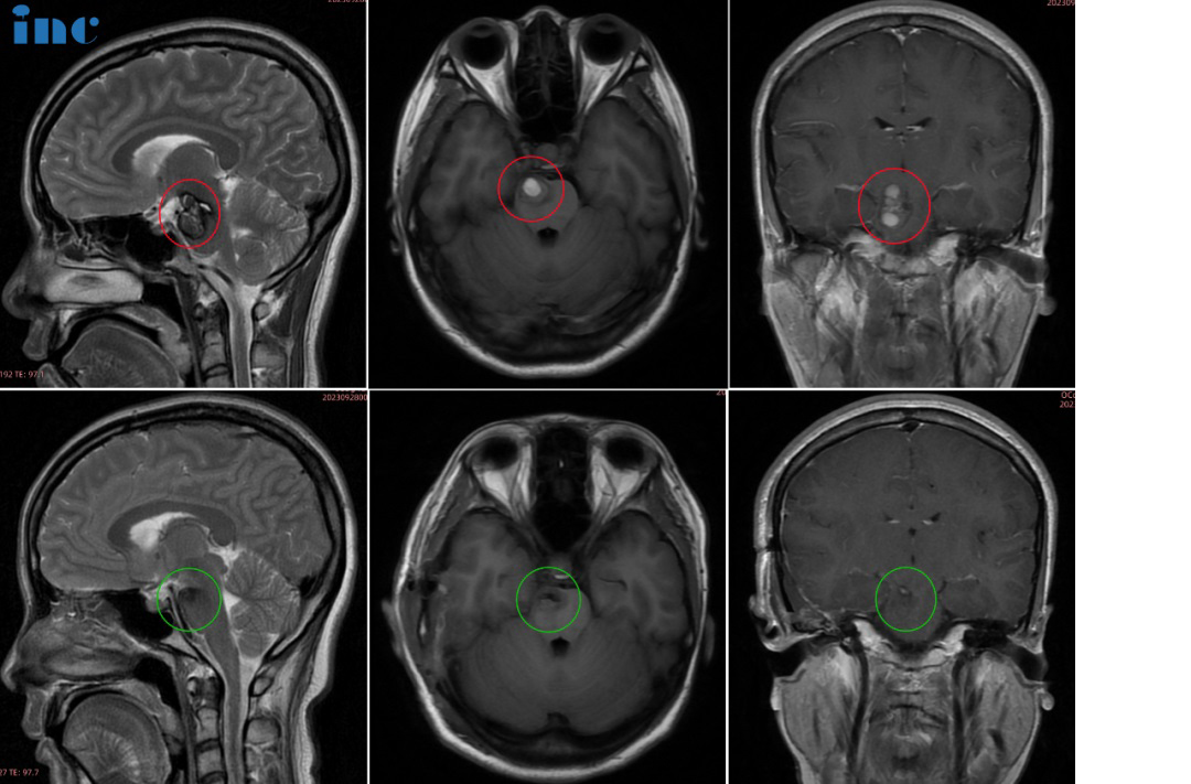 30岁女士•脑干-中脑及桥脑海绵状血管瘤