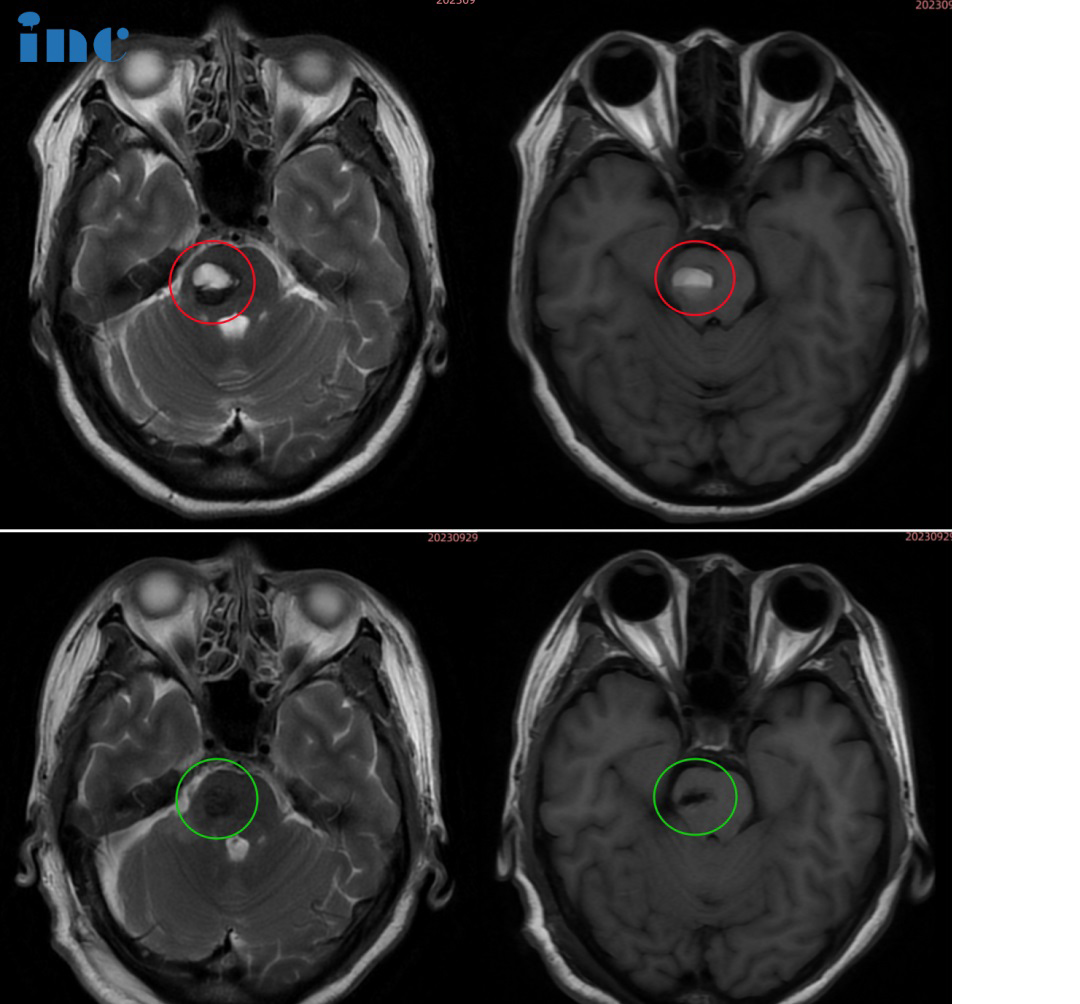 52岁女性•脑干-脑桥海绵状血管瘤