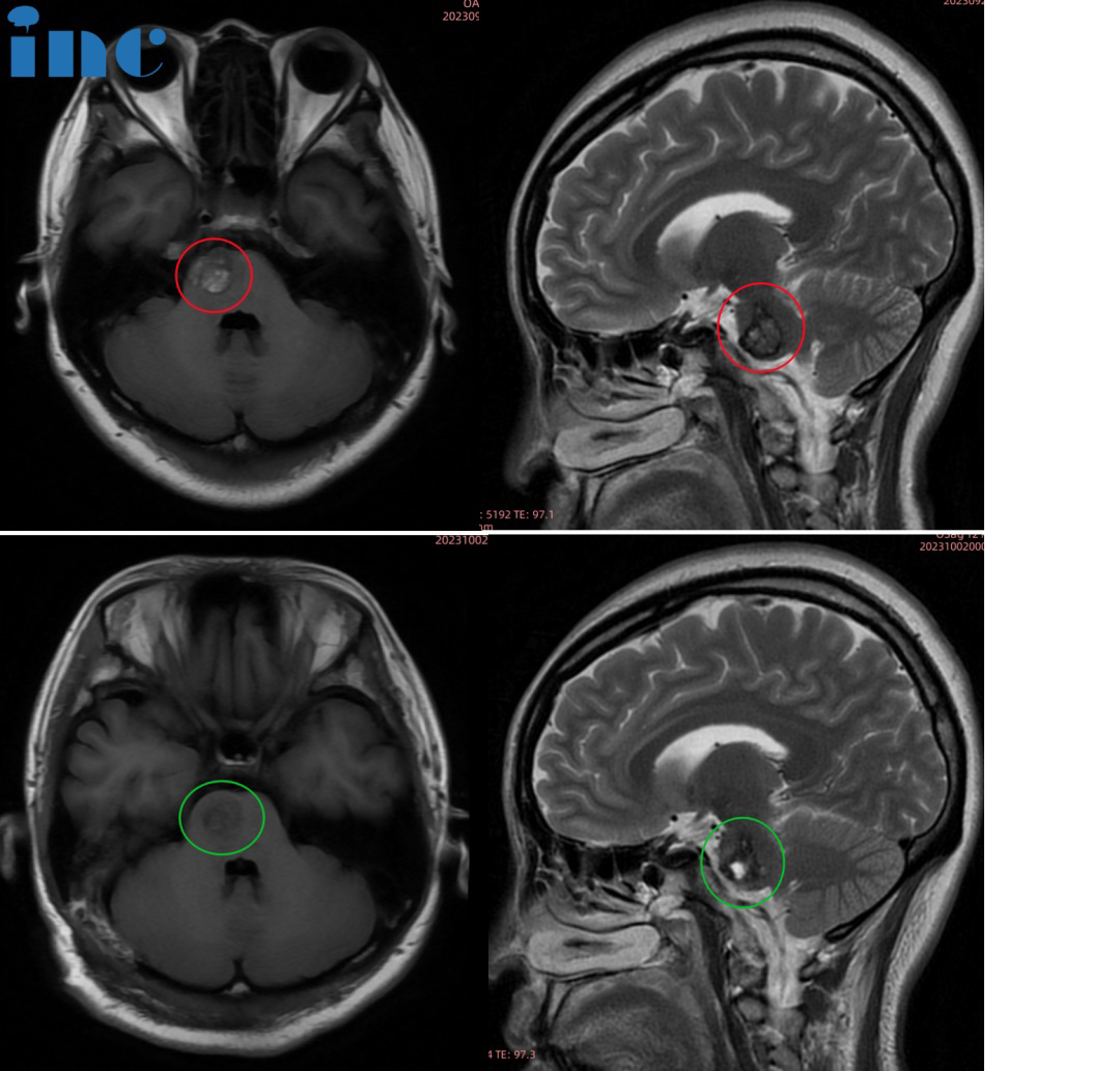 37岁女士•脑干-脑桥海绵状血管瘤