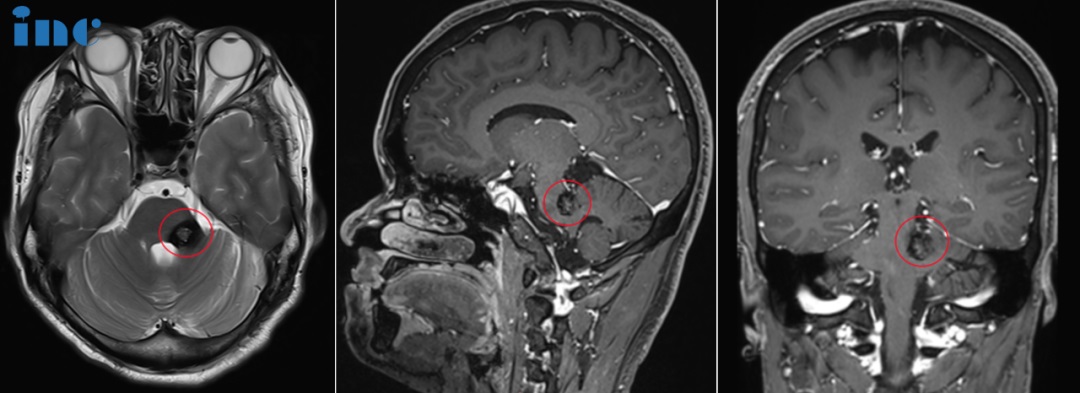 38岁男性-脑干（桥臂）海绵状血管瘤