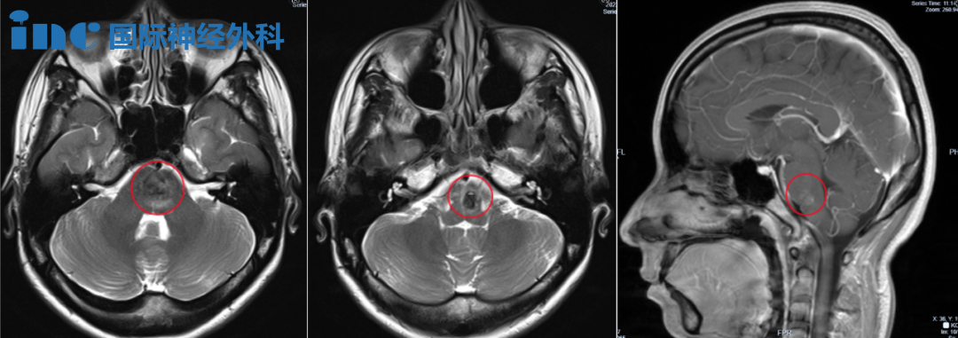 28岁女性-脑干海绵状血管瘤