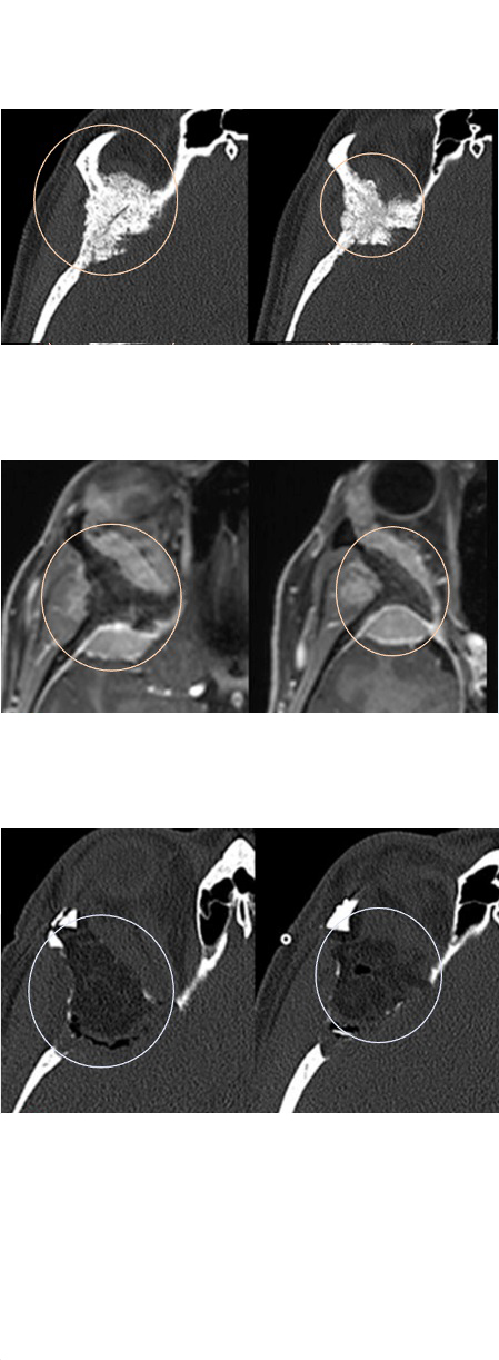 不开颅、经眉开小孔就能切除脑瘤吗？