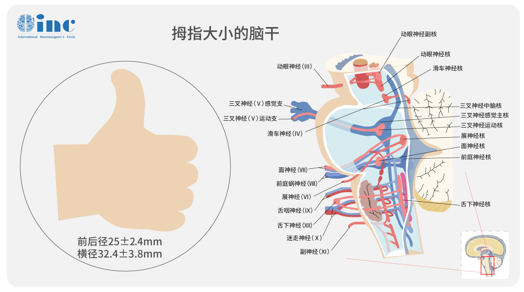 脑干海绵状血管瘤