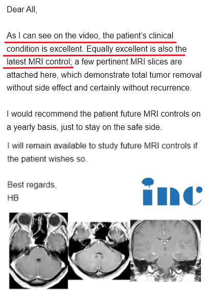 脑膜瘤伽马刀治疗无效，一台手术顺利全切、保听力、不面瘫