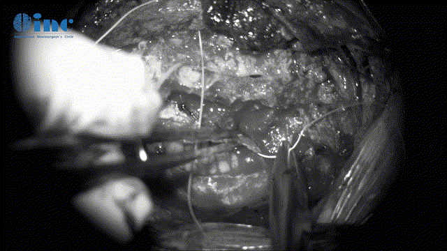 切开及悬吊脑膜膜(暴露手术入路、保护脑组织)