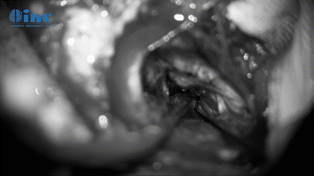 全切肿瘤后瘤腔止血及清理