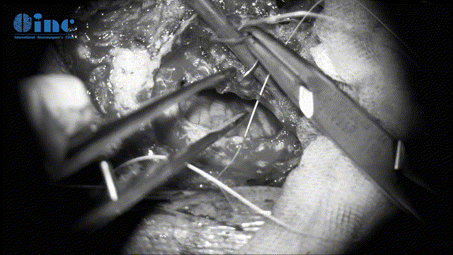 脑硬膜缝合、关颅