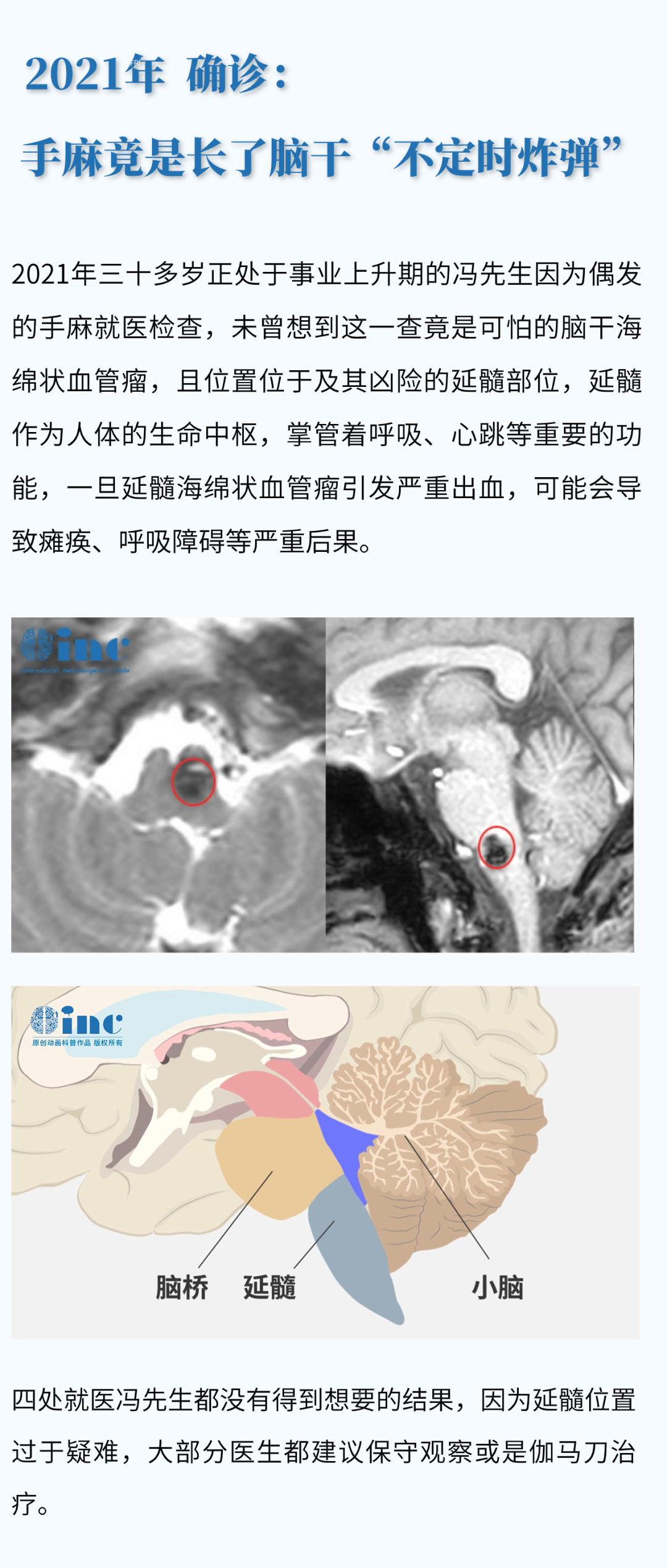 32岁脑干-延髓海绵状血管瘤患者