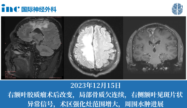 额叶胶质母细胞瘤术后症状加重偏瘫