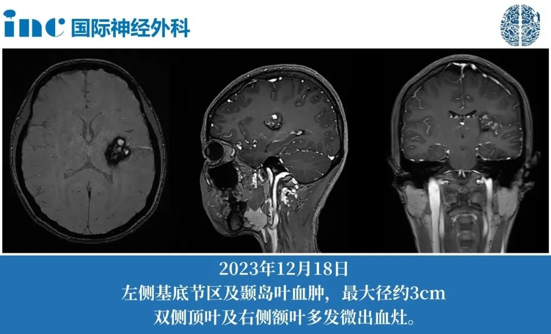 26岁女性基底节海绵状血管瘤2次出血症状加重