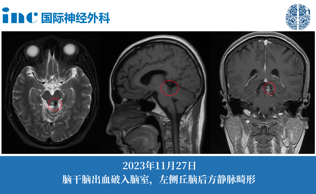 静脉畸形伴出血