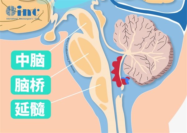 脑干肿瘤的分类及症状