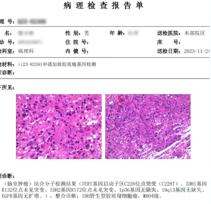 61岁男性左侧丘脑-基底节-颞叶胶质瘤