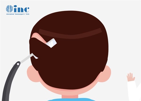 儿童顶叶胶质瘤