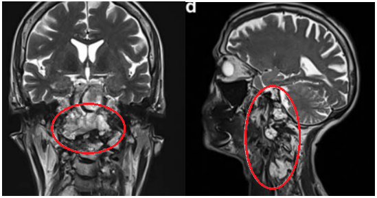 图显示脊索瘤向周边浸润生长，下至C5-C6水平的脊髓瘤侵犯浸润