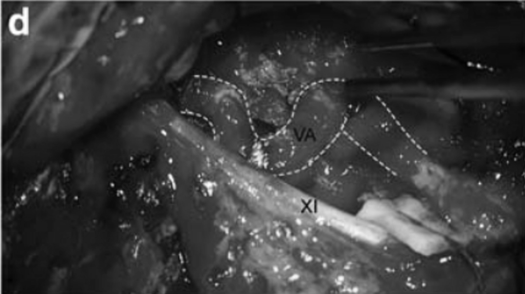将椎动脉的V3节段和部分V2节段(虚线)转位(c,d)，为切除肿瘤创造手术空间并保护动脉，髁突和下斜坡磨除骨质并在显微镜下以识别定位舌下管。