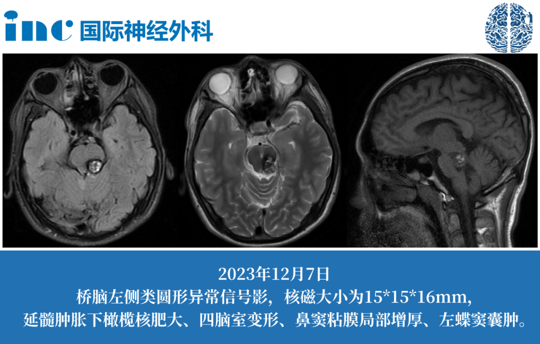 16岁男孩脑干海绵状血管瘤伴HOD，致无法自行站立，INC巴教授能安全全切吗?