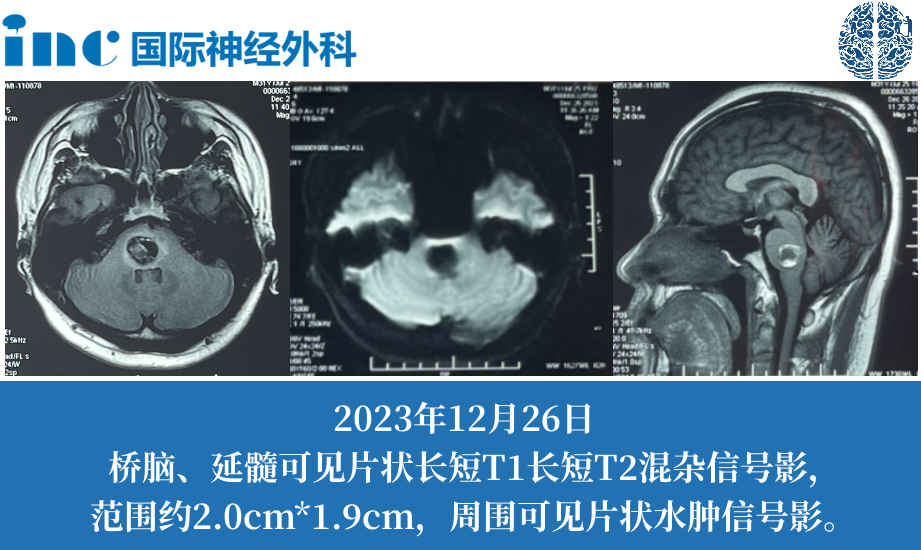 31岁男性脑干海绵状血管瘤致全身麻木