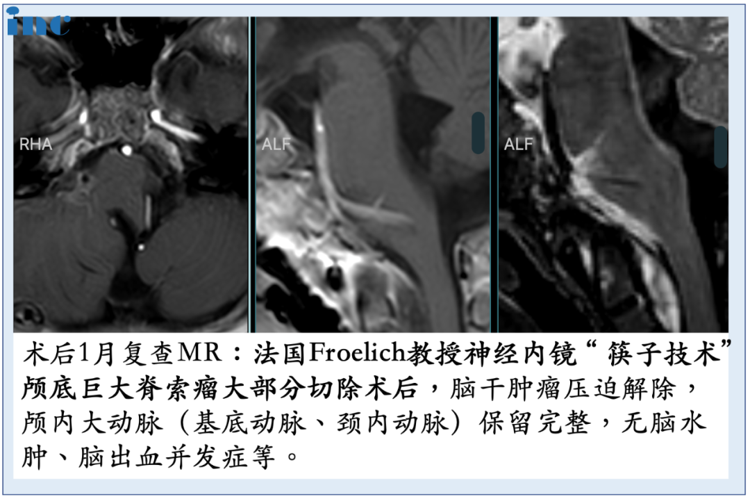 6岁男孩巨大<a href='/bingzhong/jisuoliu/' target='_blank'><u>脊索瘤</u></a>单鼻孔8mm切口、不开颅成功手术
