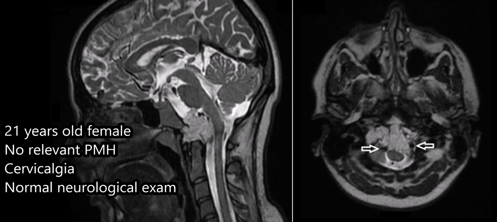 21岁女性颅颈交界处脊索瘤前外侧入路成功切除肿瘤——MR