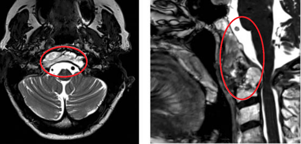 图a-b术前MR显示颅颈交界区巨大脊索瘤，51.3×74.3×25.9 mm大小，浸润性生长。