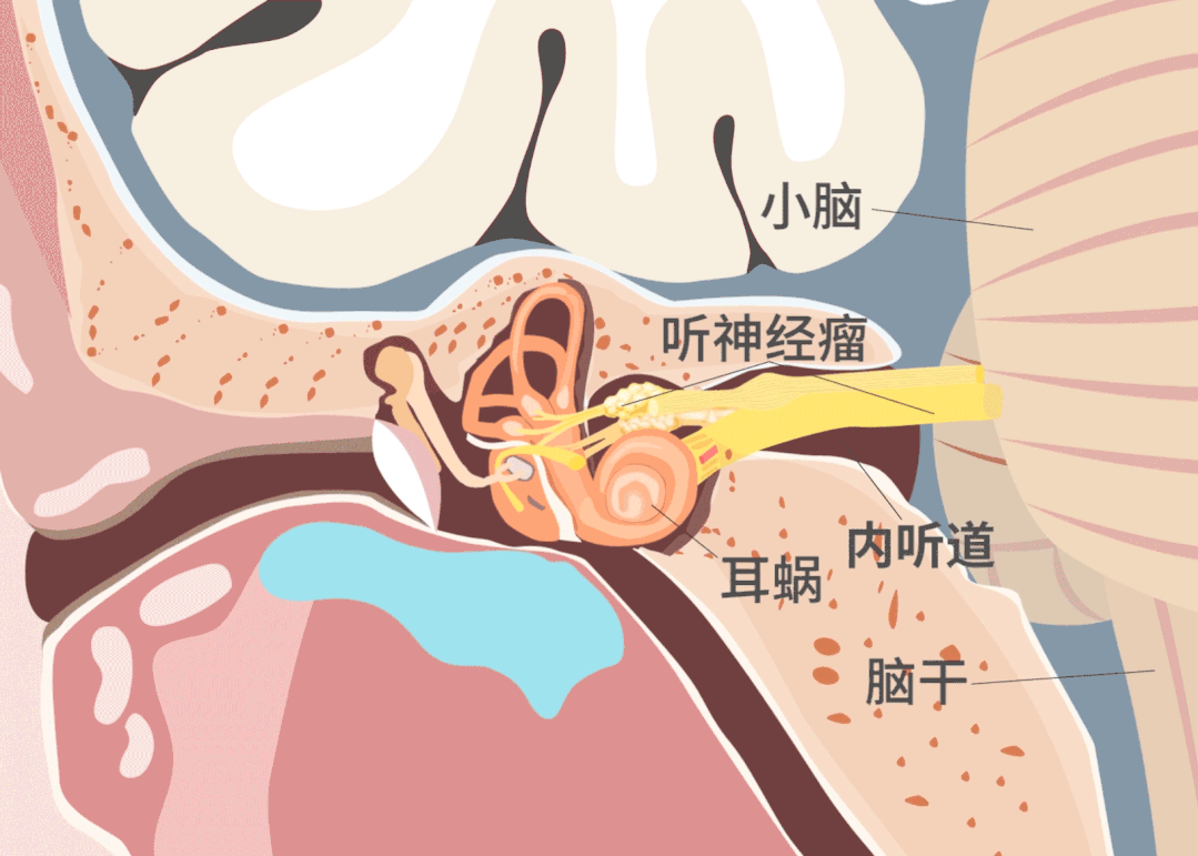 突发耳聋耳鸣也要警惕听神经瘤