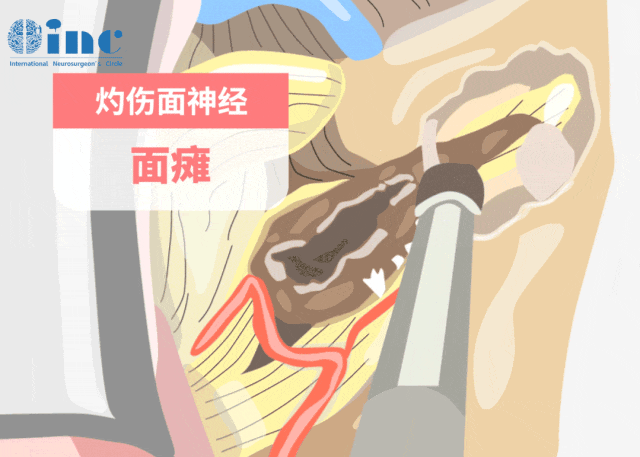 内听道磨除术及修补术