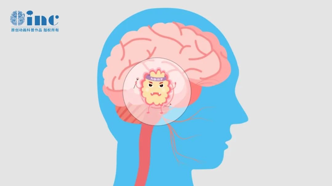 INC国际神外Rutka教授，脑干延髓-颈髓胶质瘤（CMG）咨询分析