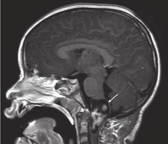 一名6岁女孩的矢状位MRI显示强化的延髓-颈髓交界处的病变。这个孩子最初表现为癫痫发作，但后来表现出进行性左侧偏瘫