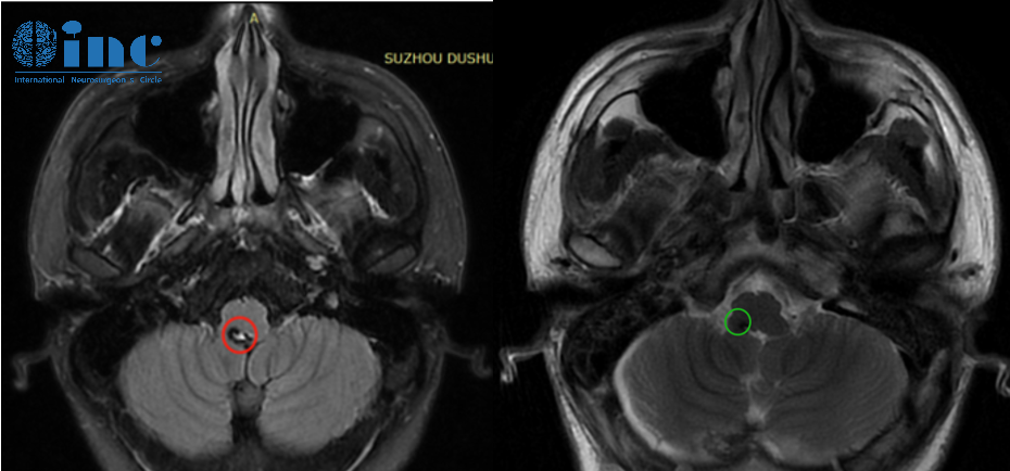 脑干海绵状血管瘤患者案例——影像