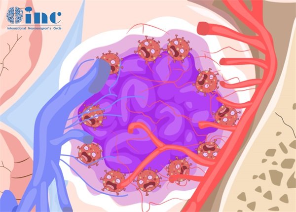 脑右侧枕叶海绵状血管瘤怎么手术
