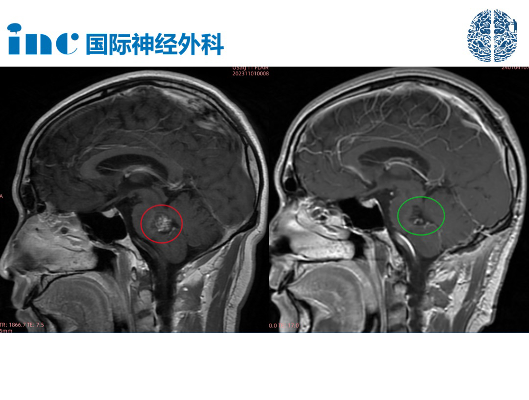 30岁男性-<a href='/qianyan/xueguanliu/' target='_blank'><u>脑干海绵状血管瘤</u></a>，可以顺利全切、无并发症吗？