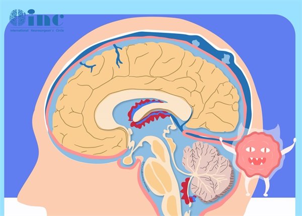 砂粒体型脑膜瘤严重吗怎么治疗