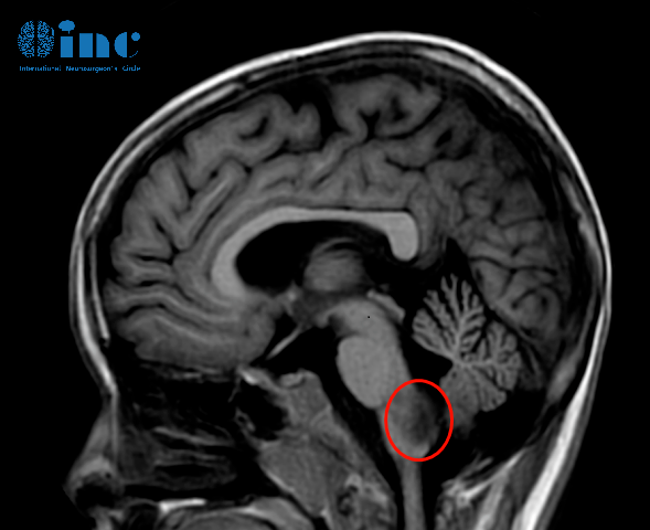 儿童脑肿瘤——影像