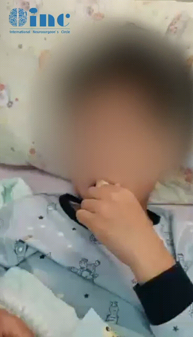 儿童脑肿瘤术后