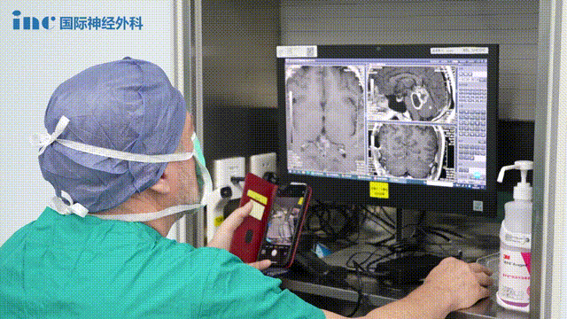 脑干中脑顶盖肿瘤并发梗阻性脑积水